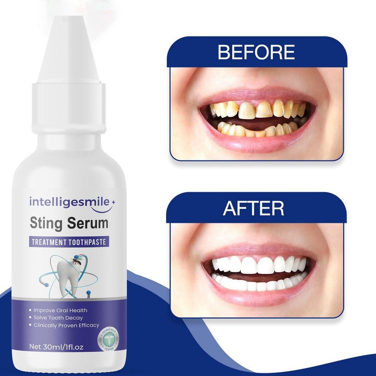 Intelligesmile Sting Serum Treatment Toothpaste 30ml Pack of 1